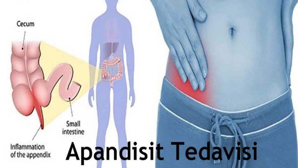 apandisit nedir nedenleri belirtisi tedavisi nelerdir saglik fit